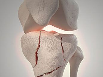 Bone Fractures & Trauma