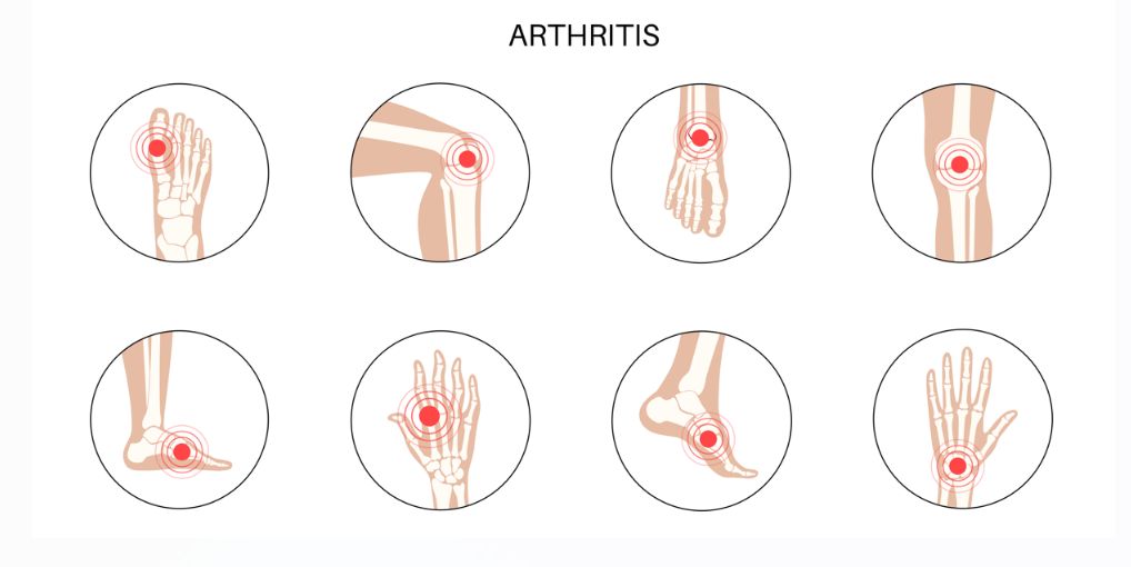 Types of Arthritis: Understanding the Differences