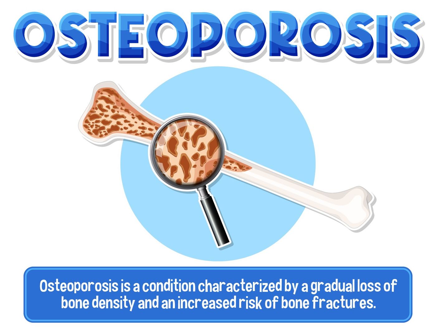 Osteoporosis: Causes, Symptoms, Diagnosis, and Treatment