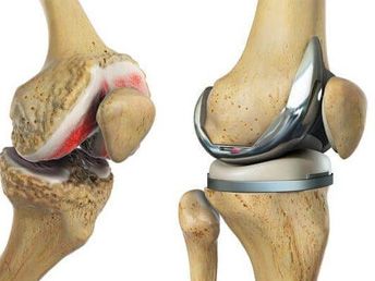 Joint Replacement