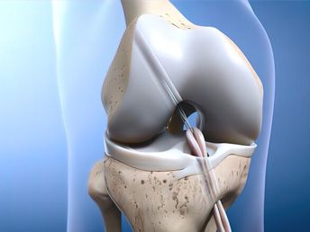 Knee Ligament Tear (ACL / PCL)